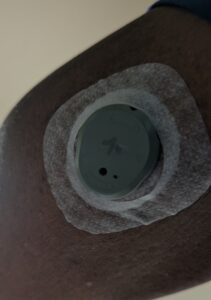 Stelo Continuous Glucose Monitor Biosensor applied to arm